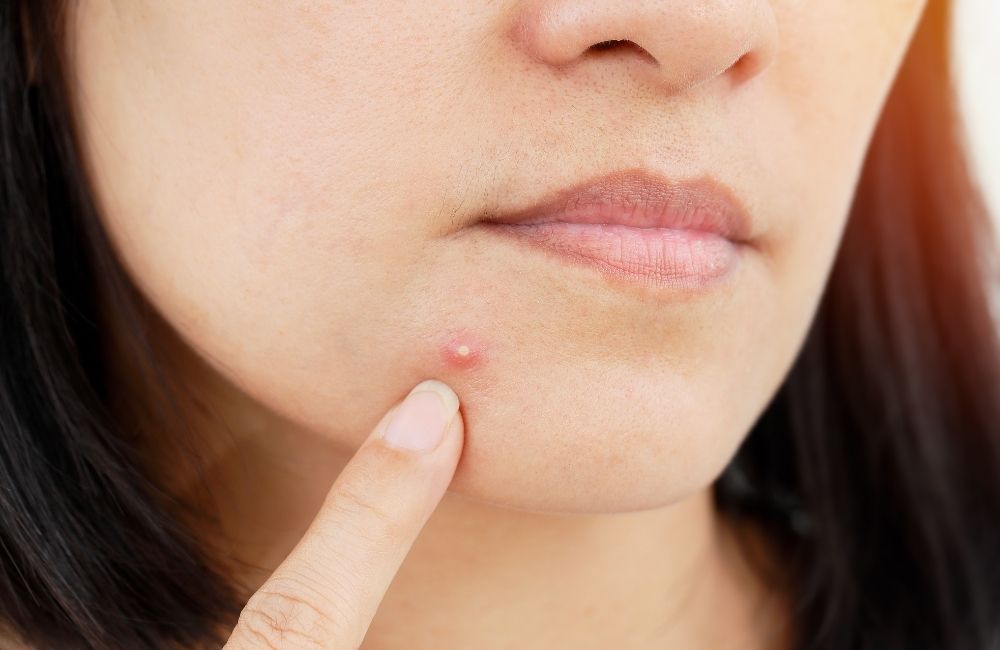 How to Stop Hormonal Acne